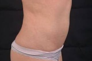 Abdominoplasty Before & After Gallery - Patient 342786 - Image 6