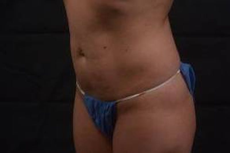 Abdominoplasty Before & After Gallery - Patient 342786 - Image 7