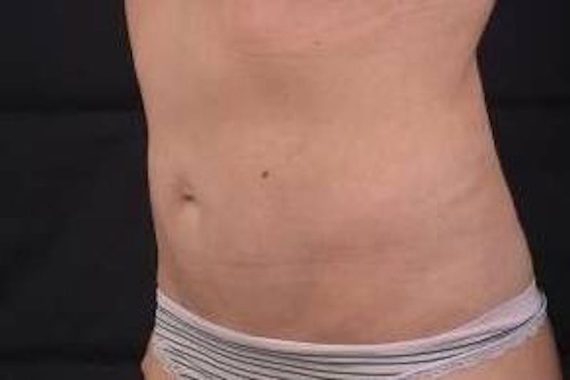 Abdominoplasty Before & After Gallery - Patient 342786 - Image 8