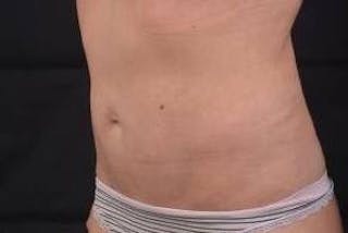 Abdominoplasty Before & After Gallery - Patient 342786 - Image 8