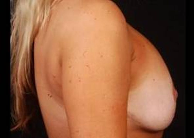 Aesthetic Breast Revision Before & After Gallery - Patient 257066 - Image 5