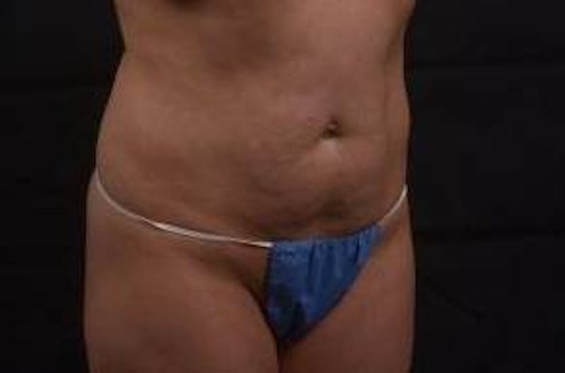Abdominoplasty Before & After Gallery - Patient 342786 - Image 9