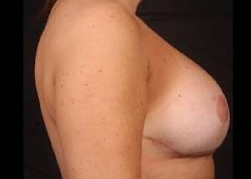 Aesthetic Breast Revision Before & After Gallery - Patient 257066 - Image 6