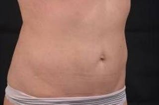 Abdominoplasty Before & After Gallery - Patient 342786 - Image 10
