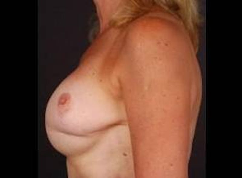 Aesthetic Breast Revision Before & After Gallery - Patient 210906 - Image 3