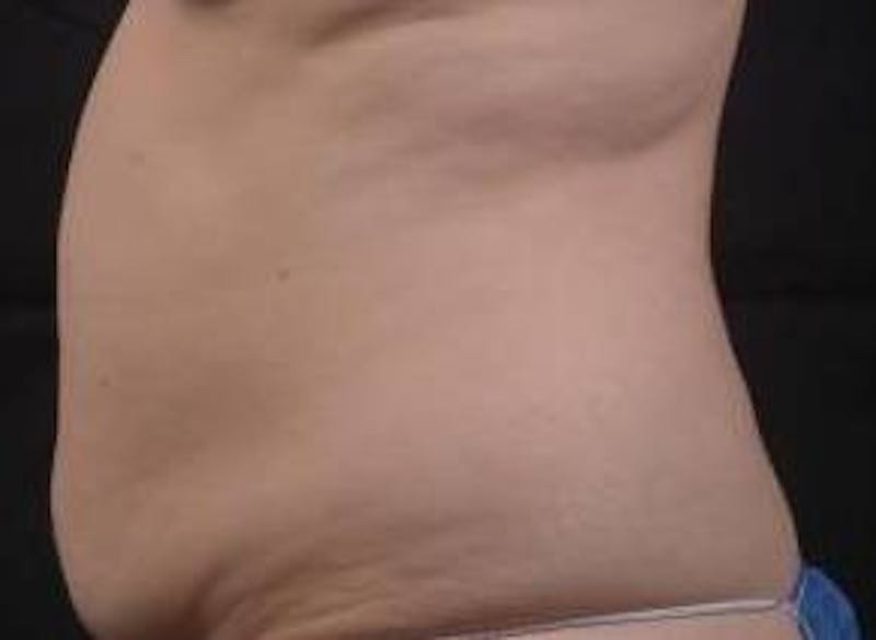 Abdominoplasty Before & After Gallery - Patient 201851 - Image 3