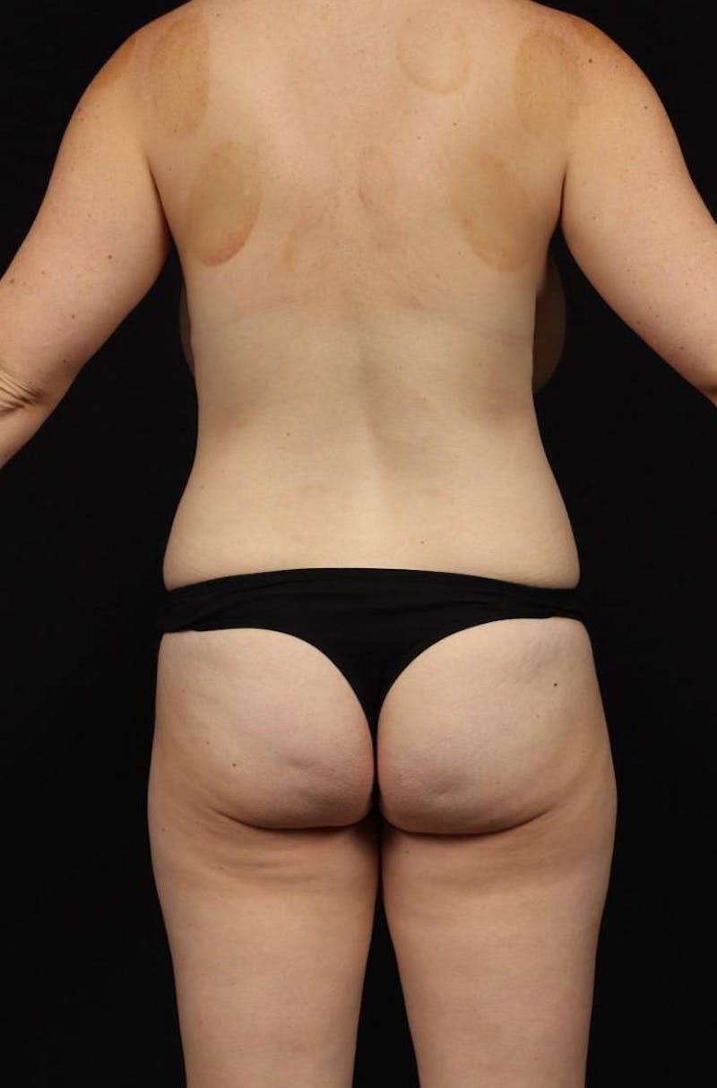 Mommy Makeover Before & After Gallery - Patient 650796 - Image 11