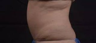 Abdominoplasty Before & After Gallery - Patient 201851 - Image 4