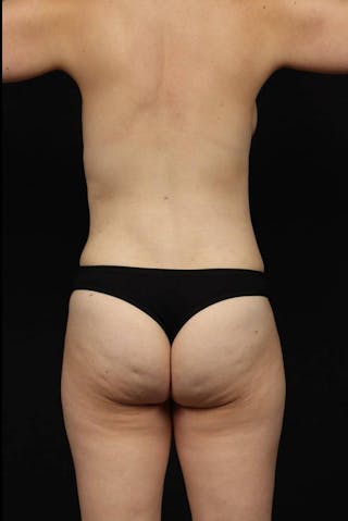 Mommy Makeover Before & After Gallery - Patient 650796 - Image 12