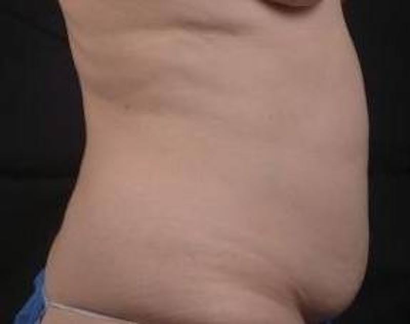 Abdominoplasty Before & After Gallery - Patient 201851 - Image 5