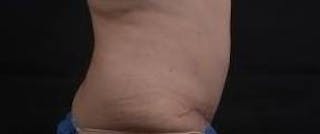 Abdominoplasty Before & After Gallery - Patient 201851 - Image 6