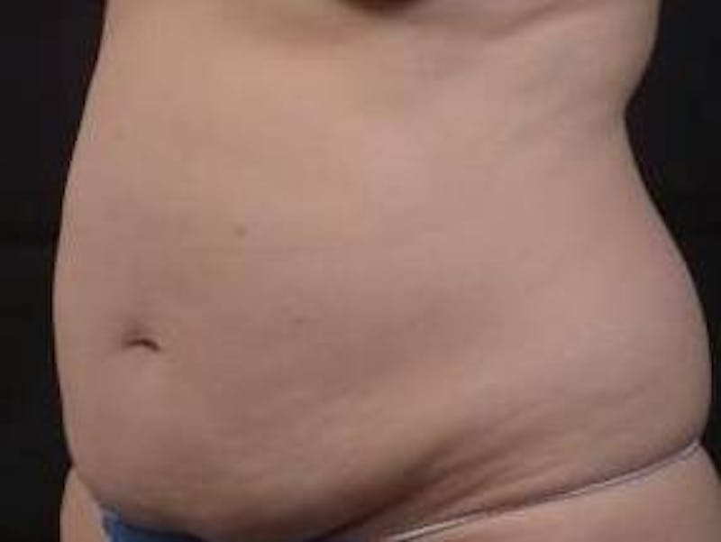 Abdominoplasty Before & After Gallery - Patient 201851 - Image 7