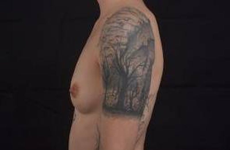 Breast Augmentation Silicone Gel Before & After Gallery - Patient 142438 - Image 3