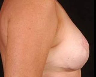 Immediate Breast Reconstruction – Nipple Sparing Before & After Gallery - Patient 567938 - Image 4