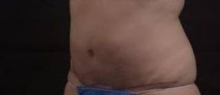 Abdominoplasty Before & After Gallery - Patient 201851 - Image 8