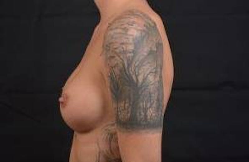 Breast Augmentation Silicone Gel Before & After Gallery - Patient 142438 - Image 4
