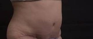 Abdominoplasty Before & After Gallery - Patient 201851 - Image 10