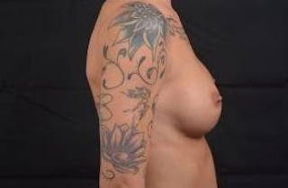 Breast Augmentation Silicone Gel Before & After Gallery - Patient 142438 - Image 6