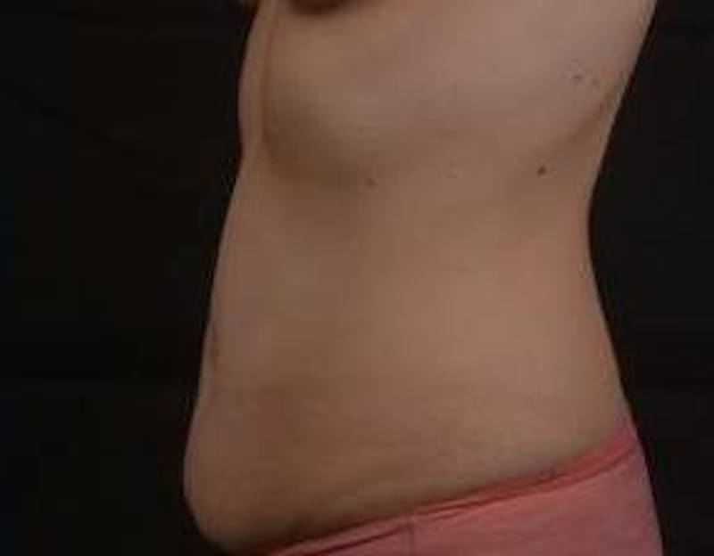 Abdominoplasty Before & After Gallery - Patient 799904 - Image 3