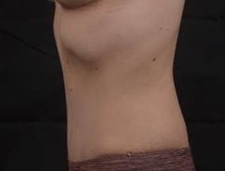 Abdominoplasty Before & After Gallery - Patient 799904 - Image 4