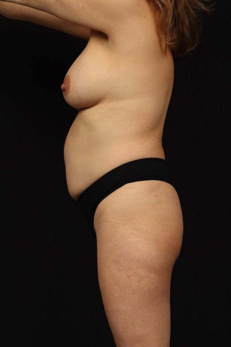 Mommy Makeover Before & After Gallery - Patient 279458 - Image 5