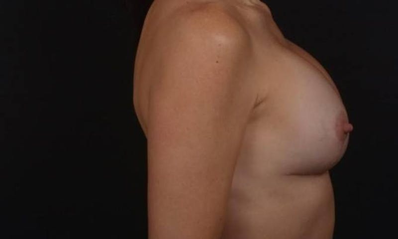 Breast Augmentation Mastopexy Before & After Gallery - Patient 282812 - Image 6