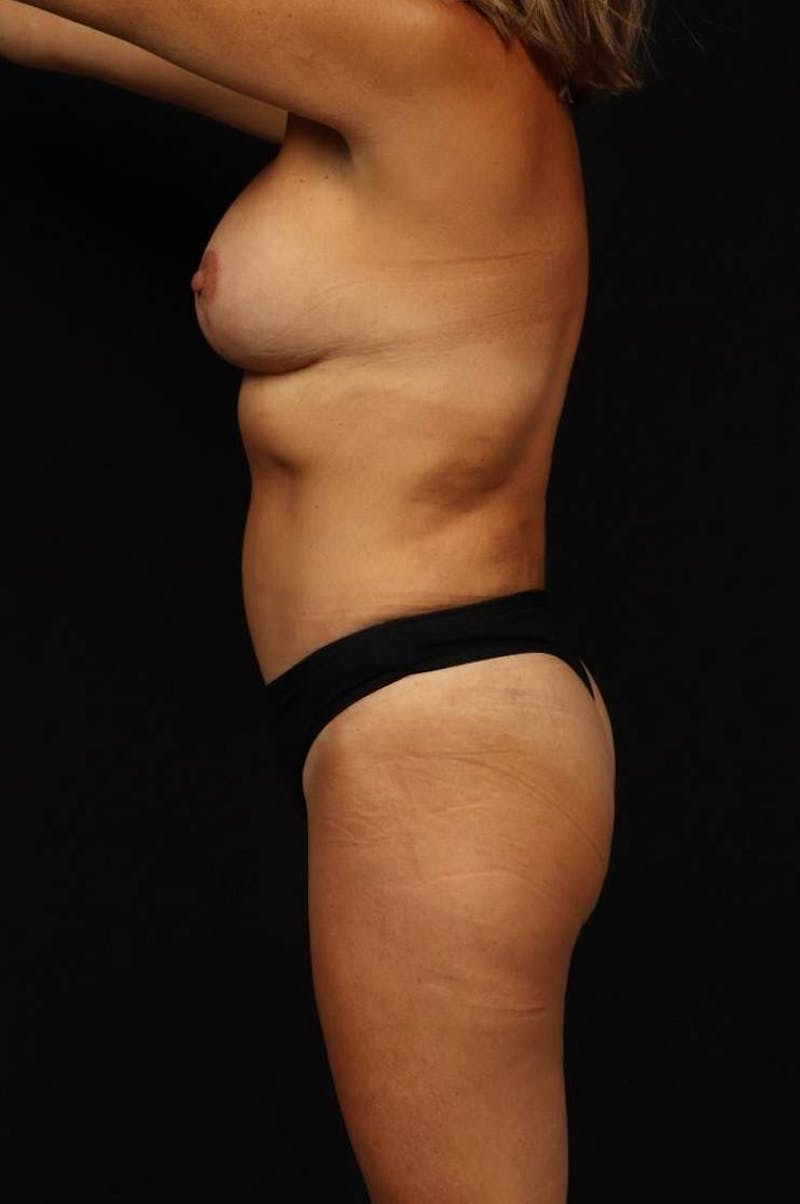 Mommy Makeover Before & After Gallery - Patient 279458 - Image 6