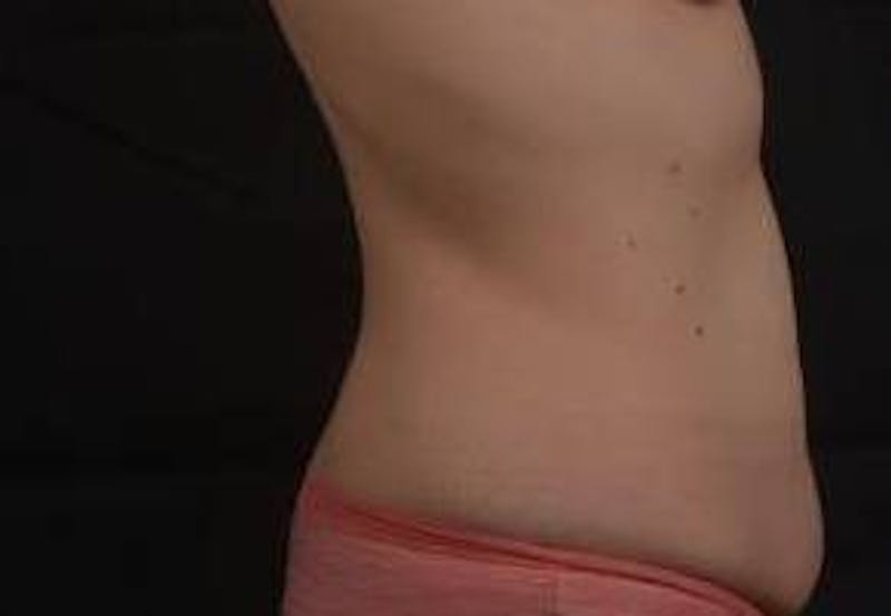 Abdominoplasty Before & After Gallery - Patient 799904 - Image 5