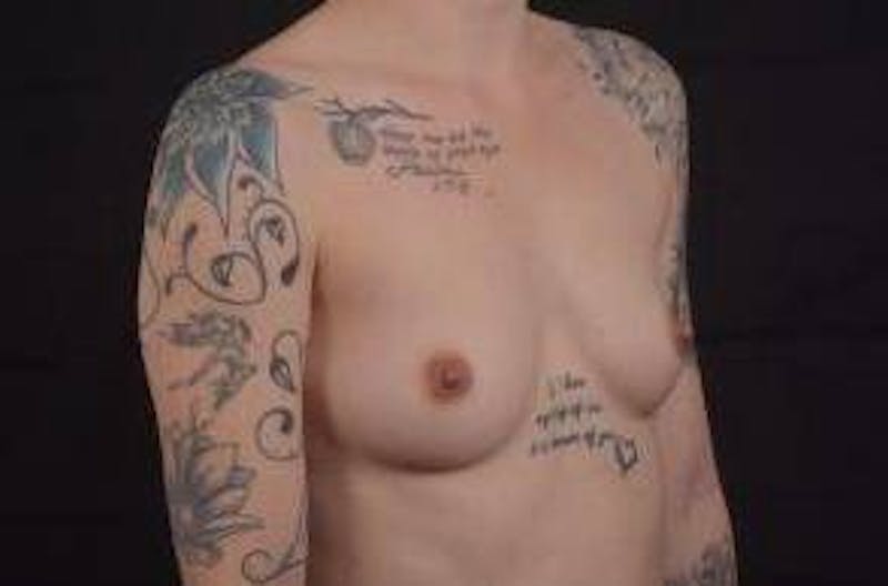 Breast Augmentation Silicone Gel Before & After Gallery - Patient 142438 - Image 9