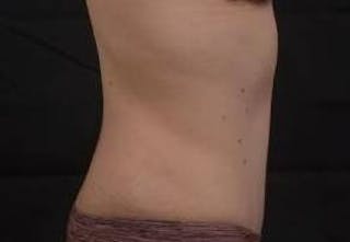 Abdominoplasty Before & After Gallery - Patient 799904 - Image 6