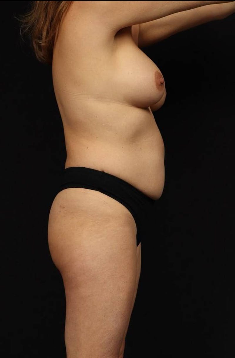 Mommy Makeover Before & After Gallery - Patient 279458 - Image 9