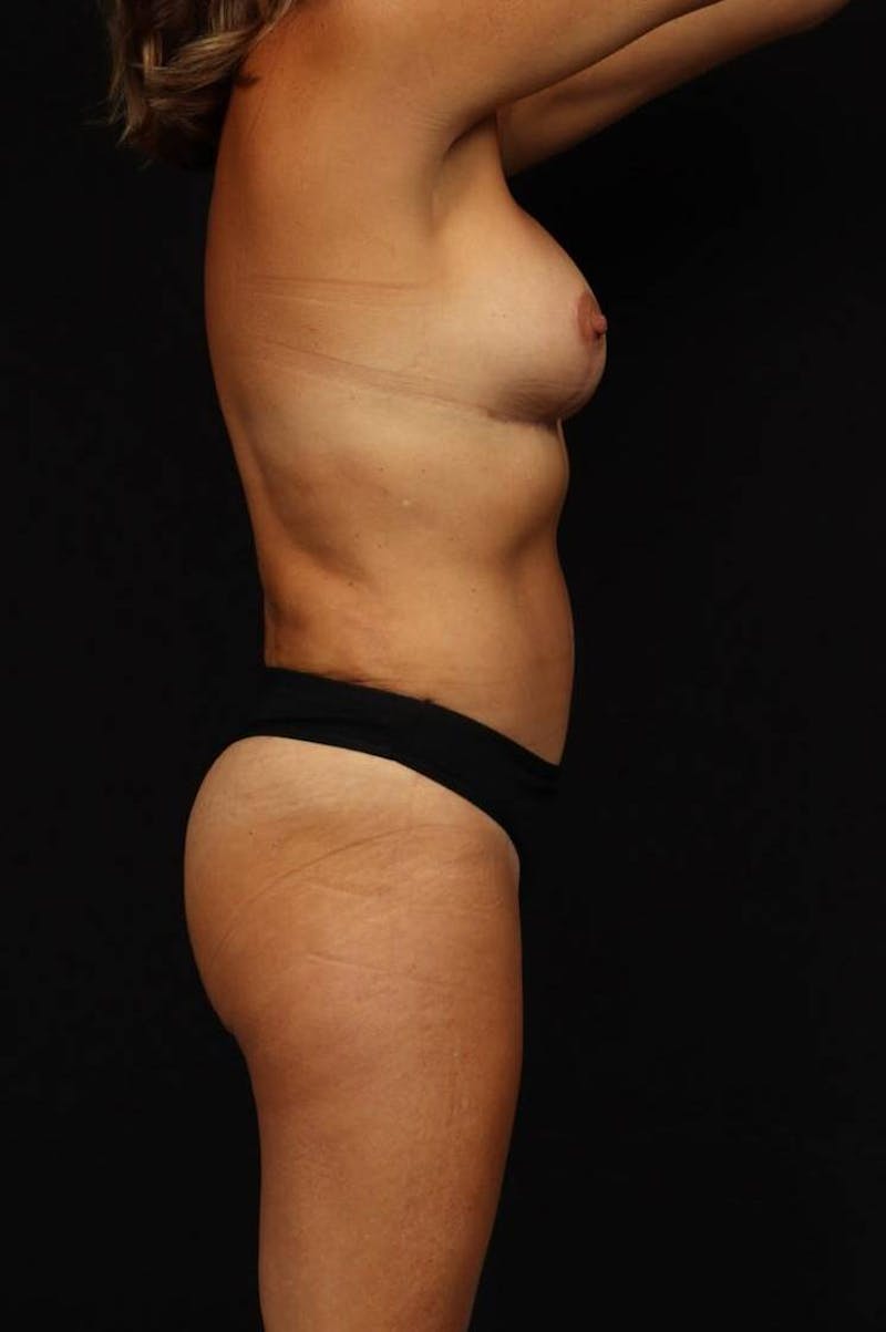 Mommy Makeover Before & After Gallery - Patient 279458 - Image 10