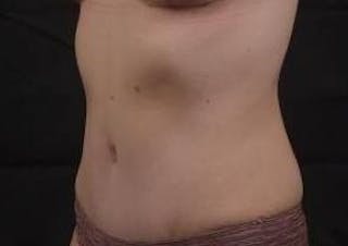 Abdominoplasty Before & After Gallery - Patient 799904 - Image 8