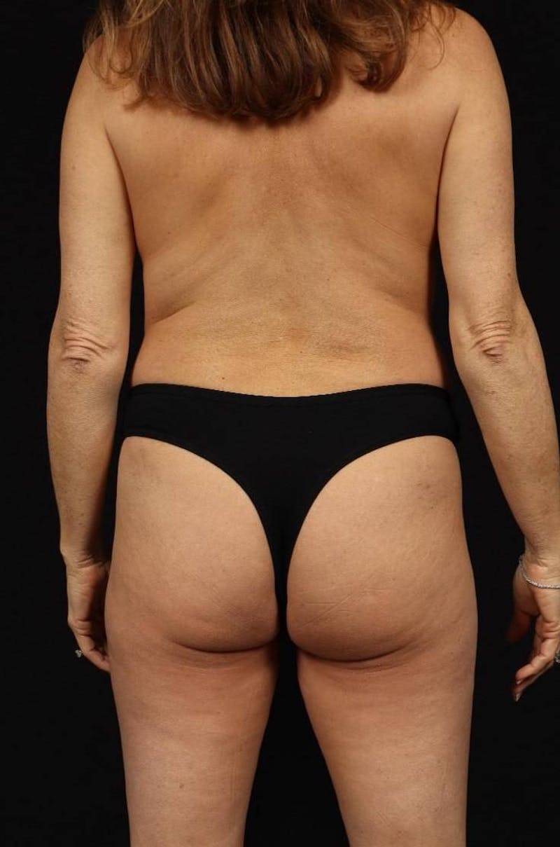 Mommy Makeover Before & After Gallery - Patient 279458 - Image 11