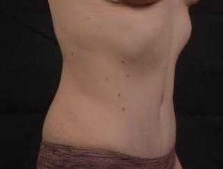 Abdominoplasty Before & After Gallery - Patient 799904 - Image 10