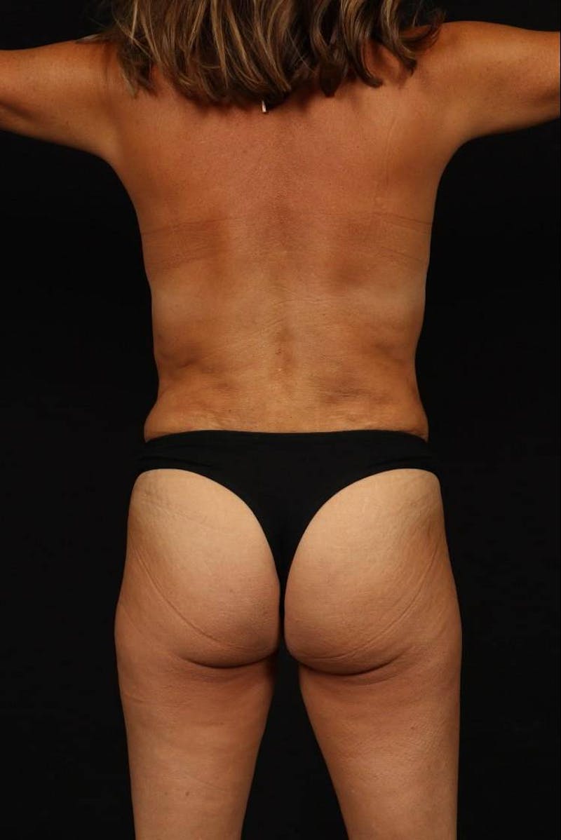 Mommy Makeover Before & After Gallery - Patient 279458 - Image 12