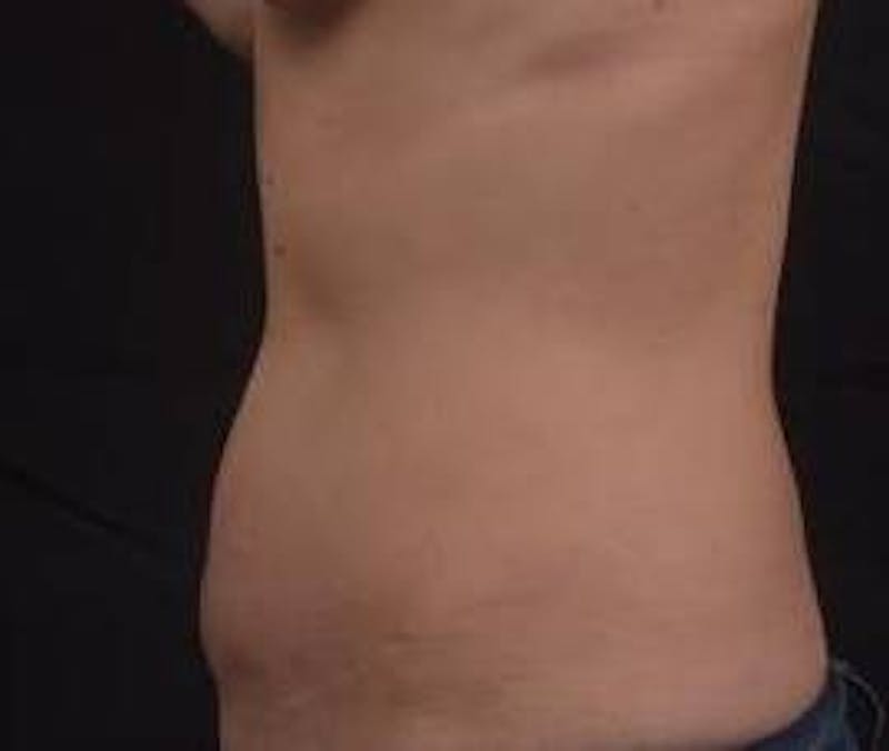 Abdominoplasty Before & After Gallery - Patient 126687 - Image 3