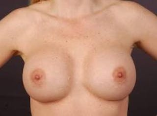 Aesthetic Breast Revision Before & After Gallery - Patient 404835 - Image 10