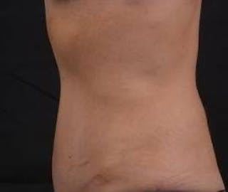 Abdominoplasty Before & After Gallery - Patient 126687 - Image 4