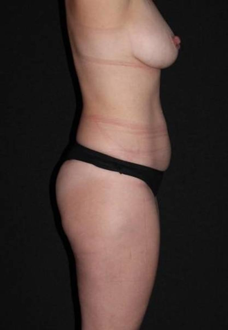 Mommy Makeover Before & After Gallery - Patient 259374 - Image 9