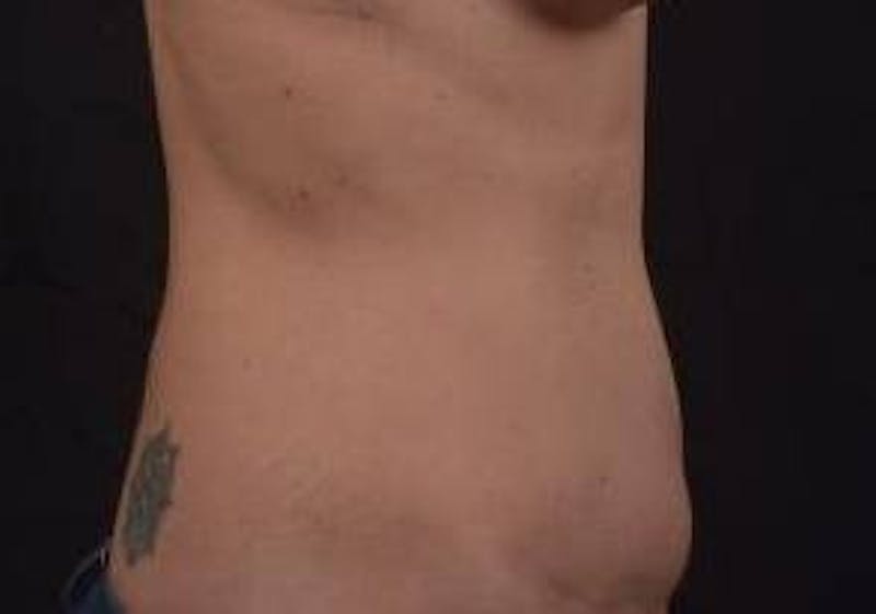 Abdominoplasty Before & After Gallery - Patient 126687 - Image 5