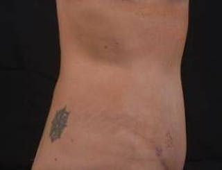 Abdominoplasty Before & After Gallery - Patient 126687 - Image 6