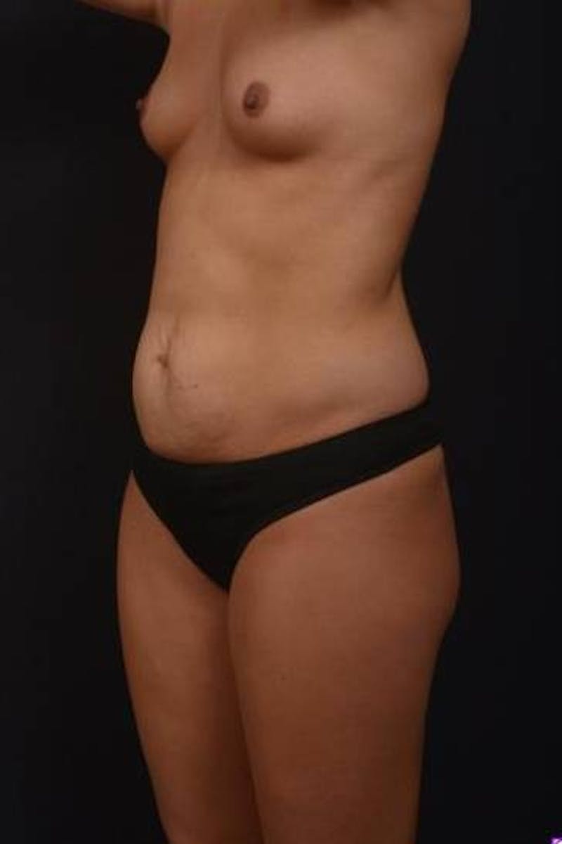 Mommy Makeover Before & After Gallery - Patient 281307 - Image 3