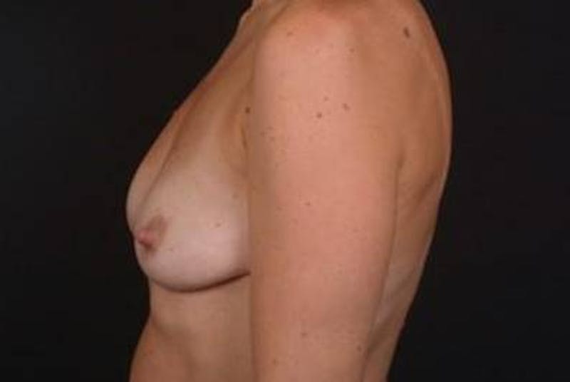 Breast Augmentation Mastopexy Before & After Gallery - Patient 301844 - Image 7