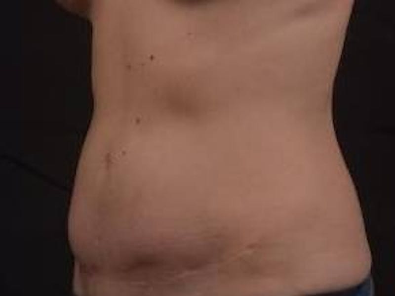 Abdominoplasty Before & After Gallery - Patient 126687 - Image 7