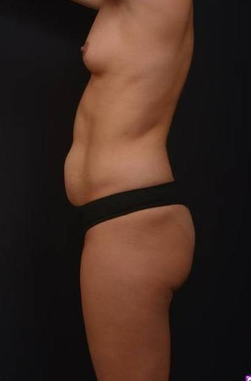 Mommy Makeover Before & After Gallery - Patient 281307 - Image 5