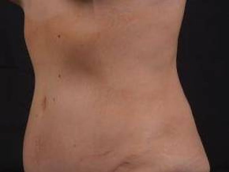 Abdominoplasty Before & After Gallery - Patient 126687 - Image 8