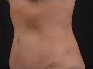 Abdominoplasty Before & After Gallery - Patient 126687 - Image 8