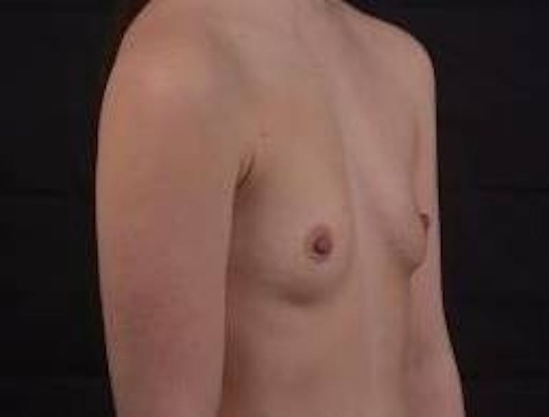 Breast Augmentation Silicone Gel Before & After Gallery - Patient 324281 - Image 9