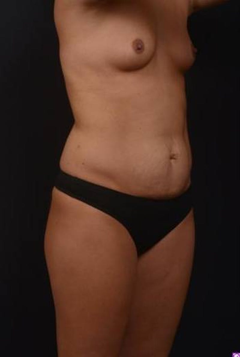 Mommy Makeover Before & After Gallery - Patient 281307 - Image 7